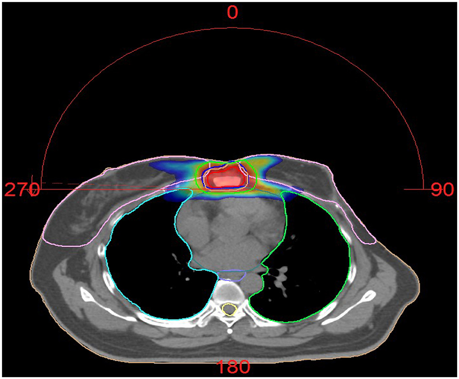 CT scan image of the chest showing a color-coded overlay indicating radiation dose levels. The brightest area, in red, is centered around the upper chest, with gradients of blue, green, and purple radiating outward. Circular degree markers are present at the top.