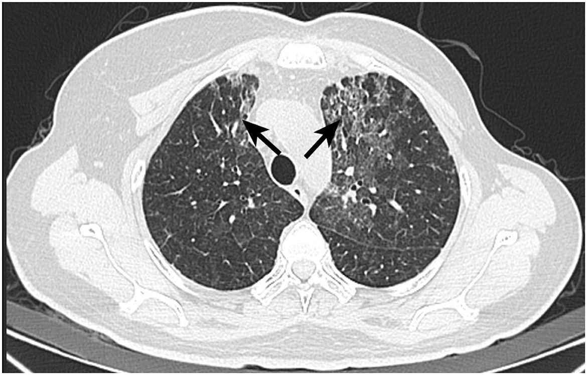 CT scan of a chest showing both lungs with significant fibrotic changes. The arrows point to areas of dense tissue, indicating possible interstitial lung disease.