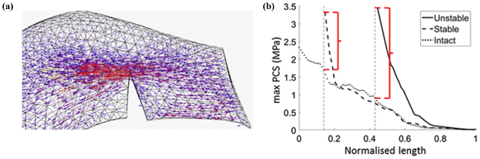 (a) A mesh structure with color gradients from blue to red, indicating stress distribution. (b) A graph showing the maximum PCS (MPa) against normalized length, with lines representing unstable, stable, and intact conditions. Red brackets highlight specific data ranges.
