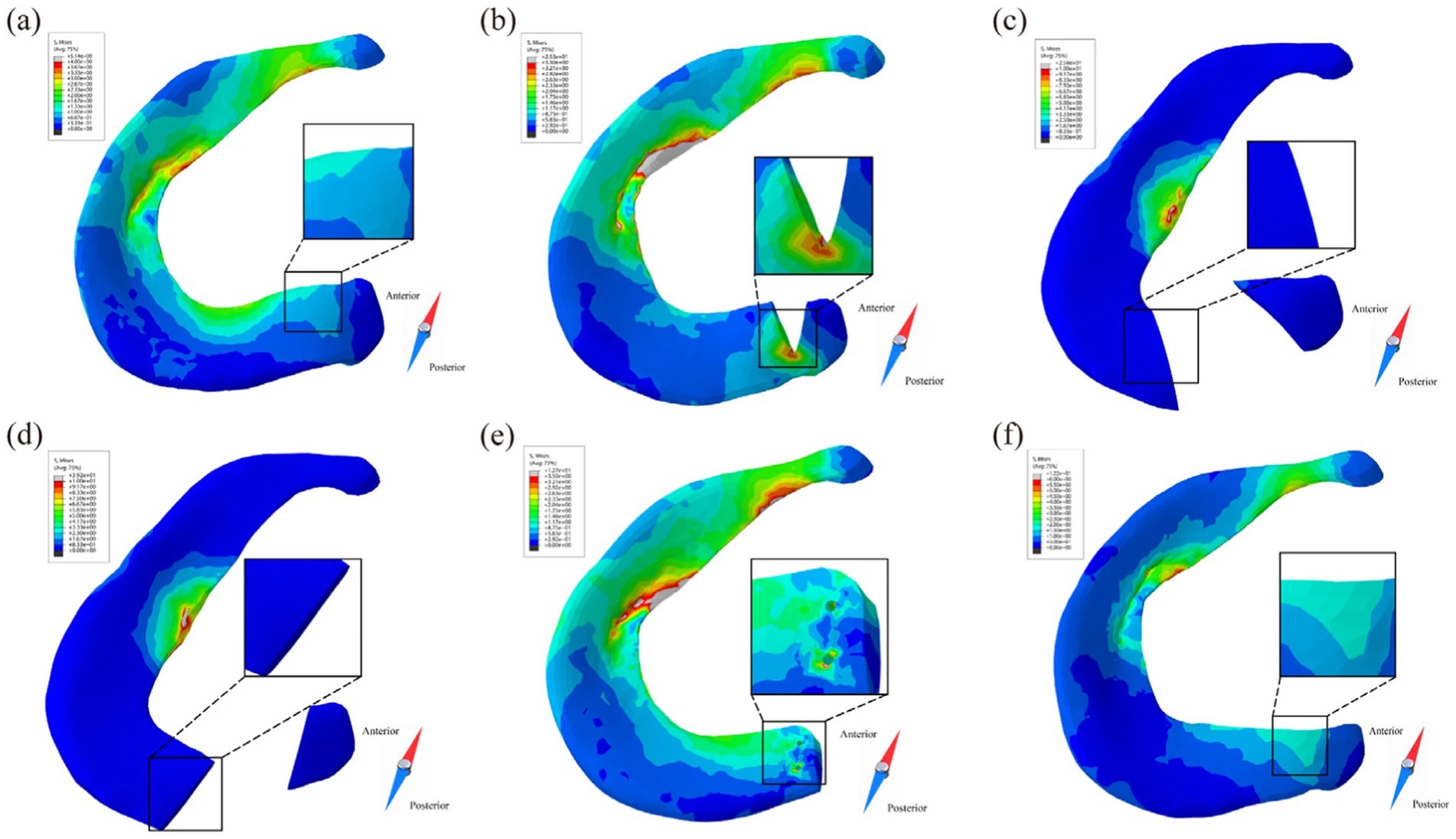 Six colored contour maps labeled a to f show stress distribution in a curved anatomical structure. Each map has a color scale ranging from red (high stress) to blue (low stress) and includes a zoomed inset highlighting specific stress areas. Notations of anterior and posterior are marked along with visual scales.