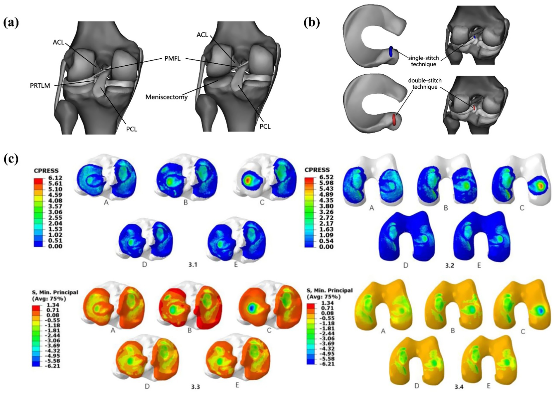 (a) Diagrams show knee anatomy with labels: ACL, PRTLM, PMFL, PCL, and meniscectomy. (b) Illustrations depict single- and double-stitch techniques on knee models. (c) Two rows of pressure maps display CPRESS and S, Min. Principal values, with color gradients indicating pressure levels from red to blue and orange to green, showing variations in stress distributions across knee sections labeled A to E.