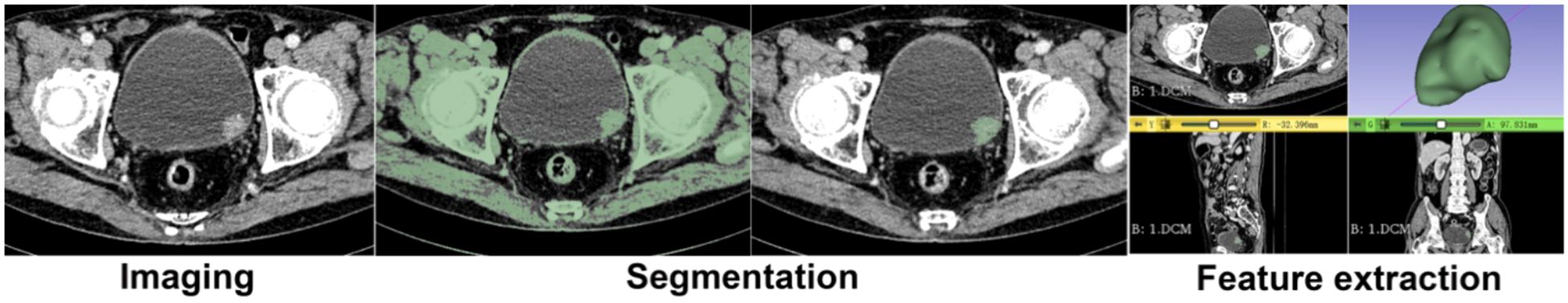 Medical image processing sequence showing three stages: Imaging, Segmentation, and Feature Extraction. The first panel shows an unprocessed scan. The second shows highlighted areas for segmentation. The final panel combines a color image and multiple scans for feature extraction.