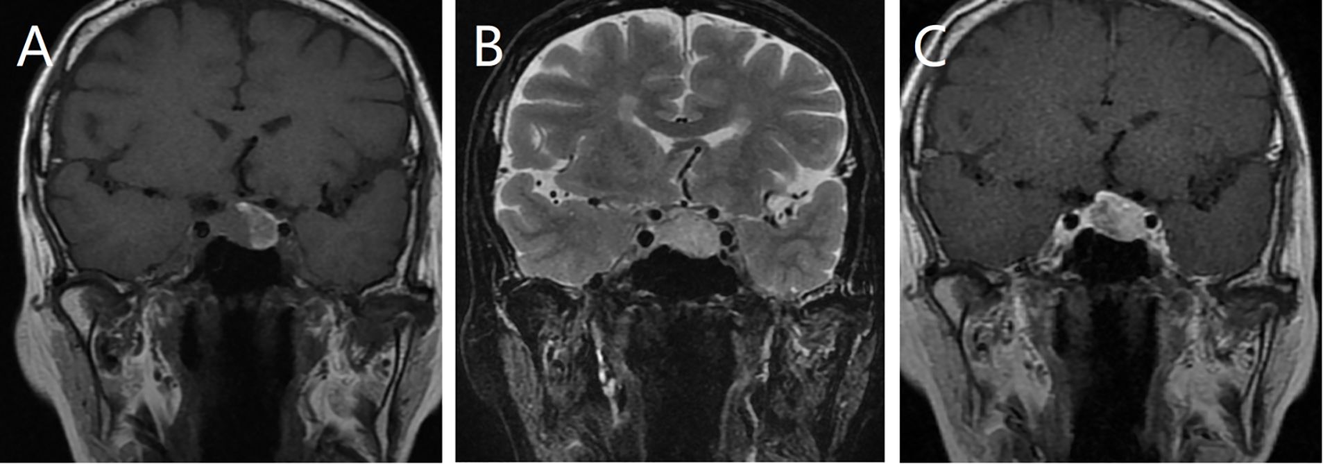 Three coronal brain MRI images labeled A, B, and C. Image A shows a T1-weighted scan with uniform dark gray matter. Image B is T2-weighted, highlighting white matter structures. Image C resembles Image A.