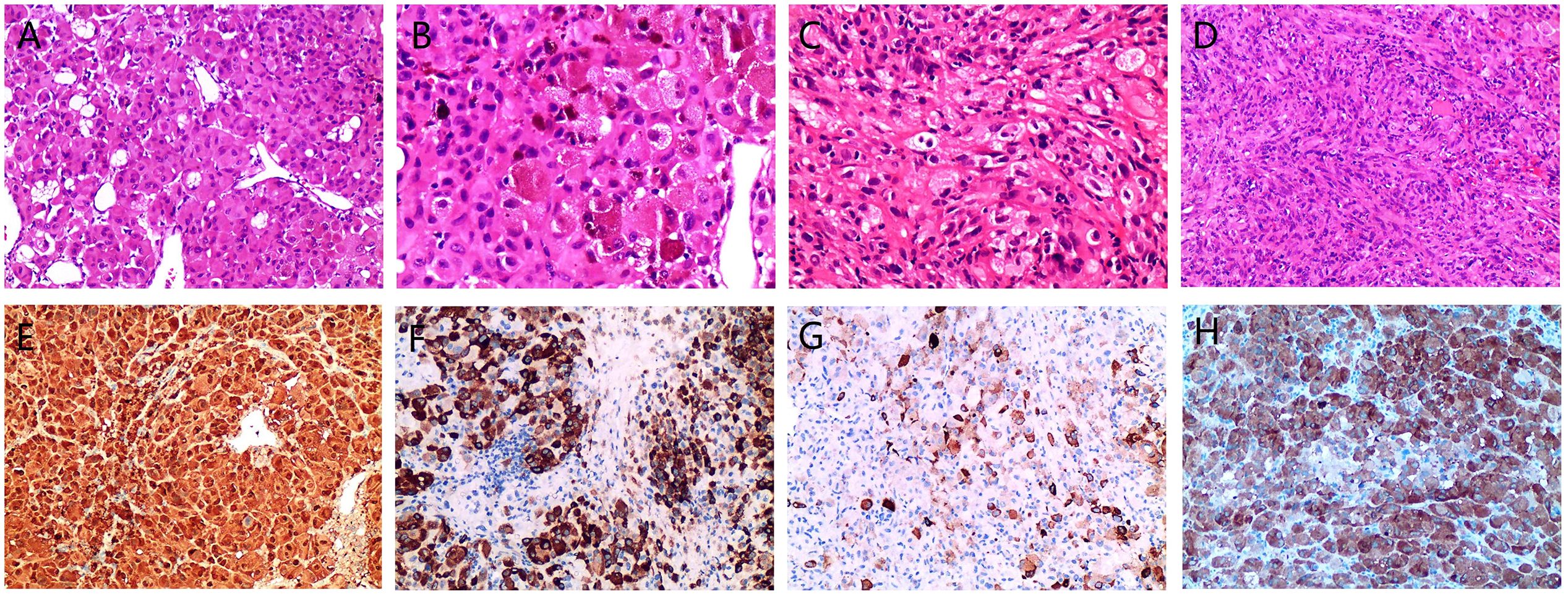 Histological images labeled A to H. A-D show tissue sections stained with hematoxylin and eosin, varying in cellular density and structure. E-H display immunohistochemistry stains, highlighting different protein expressions with brown coloring, against lighter backgrounds.
