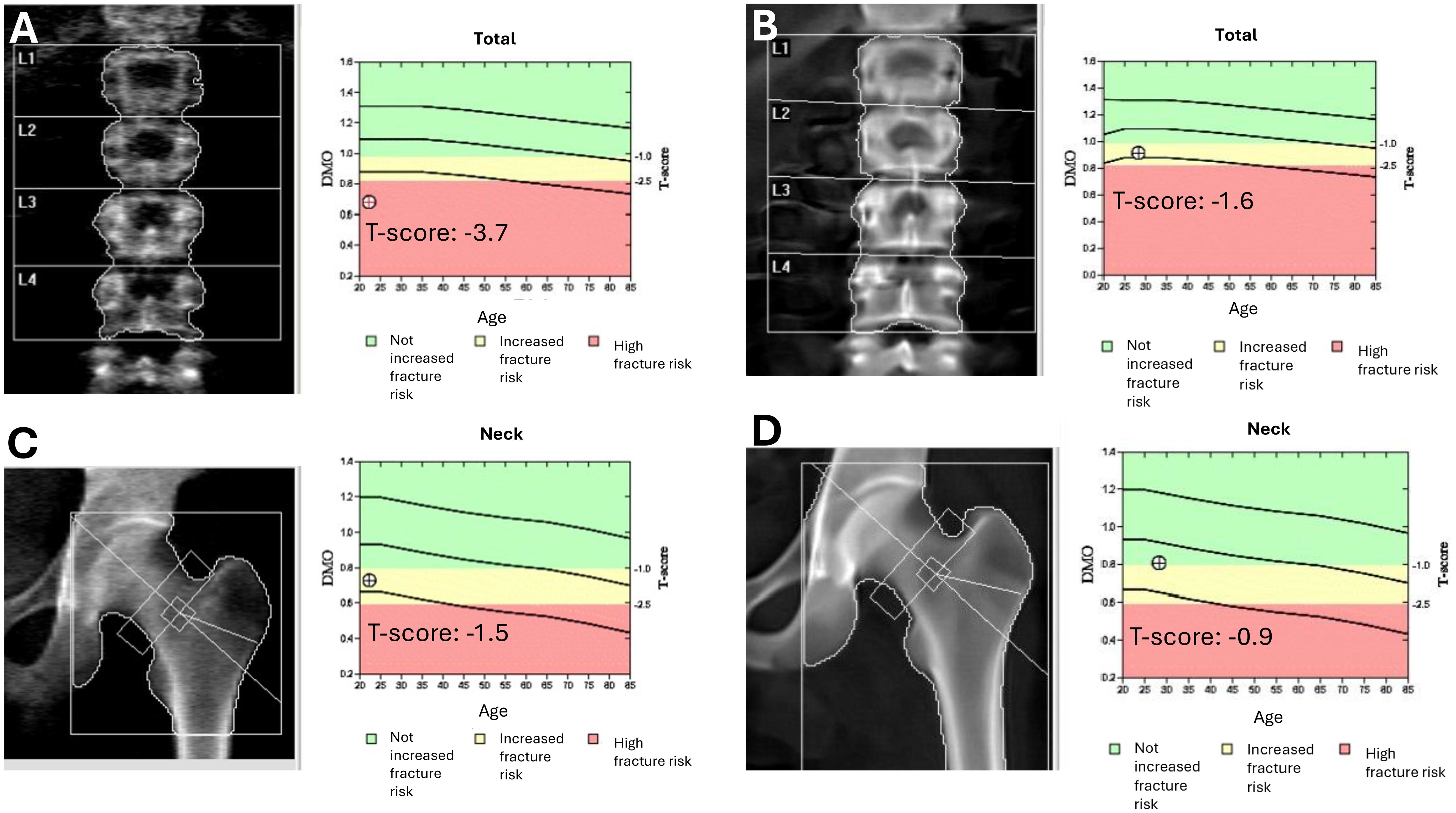 Four panels show spine and hip bone density images with corresponding charts. Panel A: Spine image labeled L1-L4, with a density chart showing a T-score of -3.7 indicating high fracture risk. Panel B: Similar spine image with a chart showing a T-score of -1.6. Panel C: Hip image with a chart showing a neck T-score of -1.5, also in the high-risk category. Panel D: Similar hip image with a chart showing a neck T-score of -0.9. Charts use color coding to denote fracture risk categories.