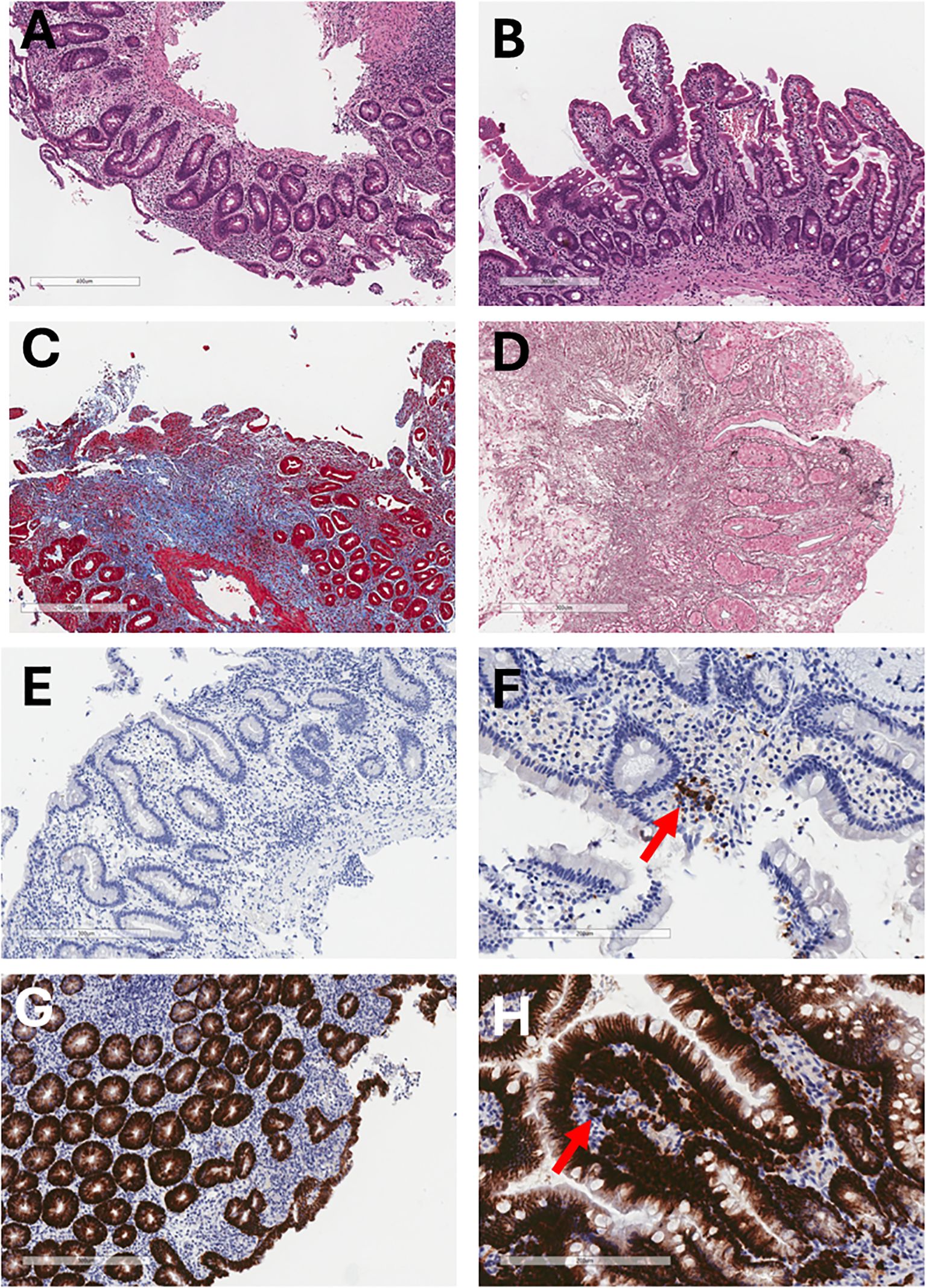 Histological images labeled A to H. A and B show tissue sections with glandular structures. C and D highlight areas stained red and blue, indicating connective tissue. E and F display blue-stained tissue with an arrow pointing to a specific cell cluster in F. G and H focus on densely packed, darkly stained cells, with an arrow in H highlighting a particular region.