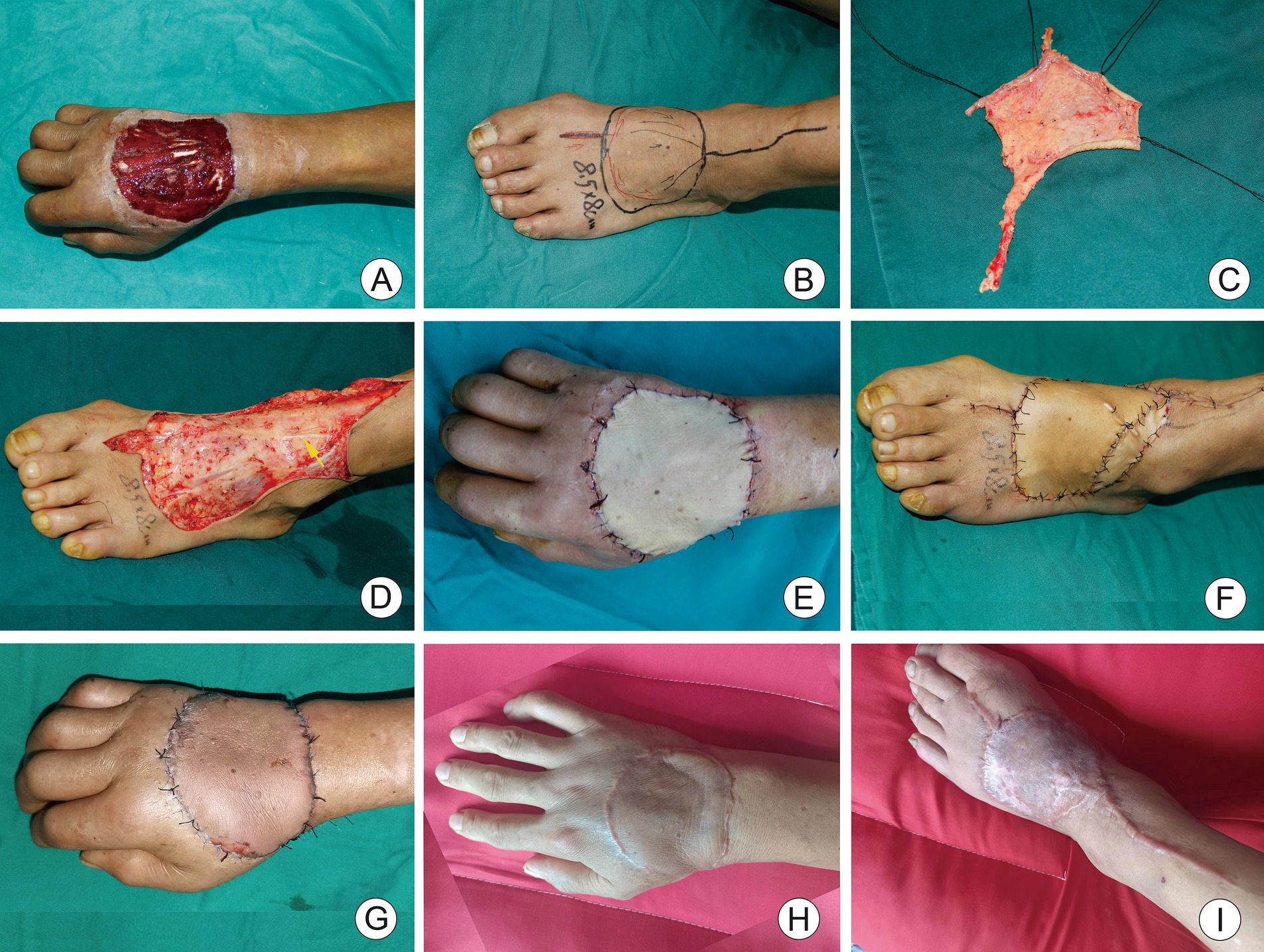 Nine-step medical procedure on the foot. Panel A: exposed wound on foot. Panel B: surgical markings on foot. Panel C: excised skin graft. Panel D: graft attached to wound. Panel E-G: foot with stitched graft. Panel H-I: healed foot with scars.