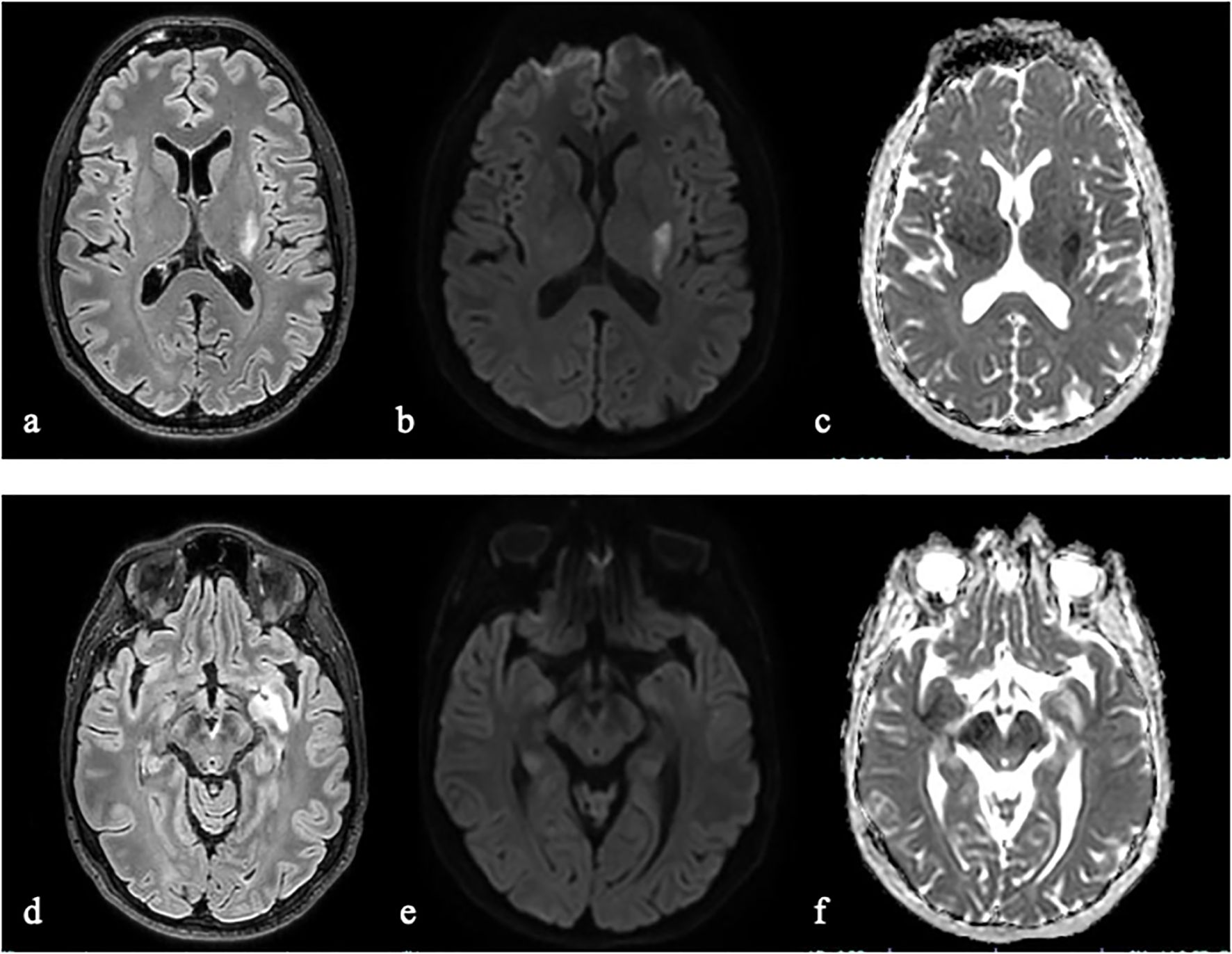 MRI scans featuring axial brain images in two rows; the top row includes images labeled a, b, c, showing varying contrasts in white and gray matter. The bottom row includes images labeled d, e, f, displaying the brainstem and surrounding structures with different contrast levels.