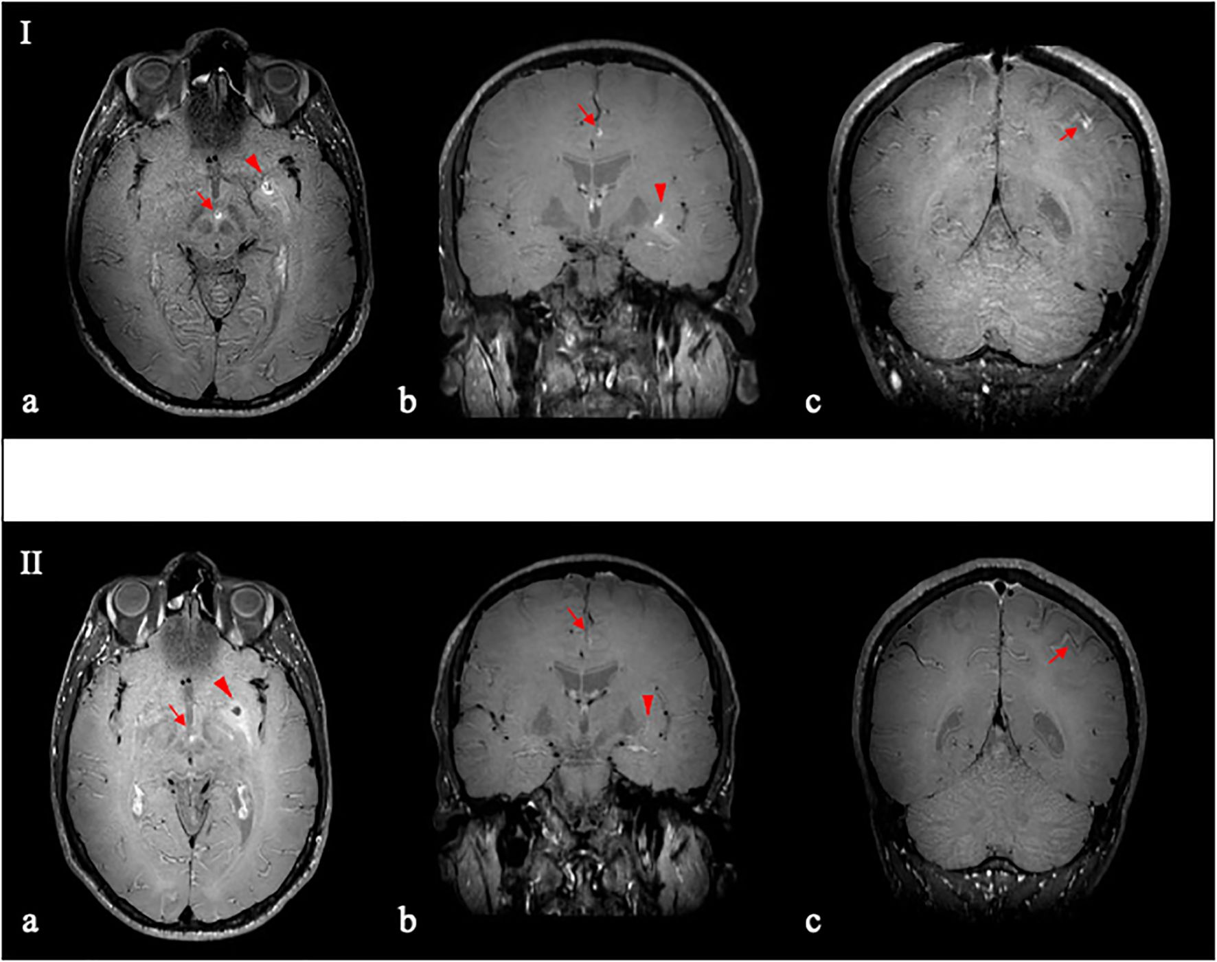 Two rows of brain MRI scans labeled I and II. Each row contains three images: a) axial, b) coronal, and c) coronal sections. Red arrows highlight specific regions in the brain tissue. The focus is on structural details and abnormalities.