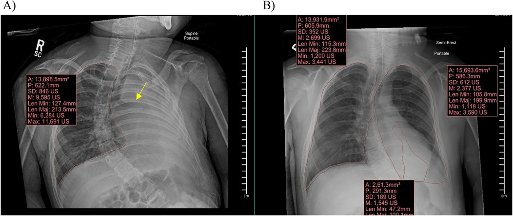 Chest X-ray images are labeled A and B. Image A shows a lateral view with measurements in a labeled box, highlighting lung areas with a yellow arrow. Image B shows an anterior view with similar measurements outlined. Both include detailed metrics such as area and length, emphasizing differences between supine and semi-erect positions.