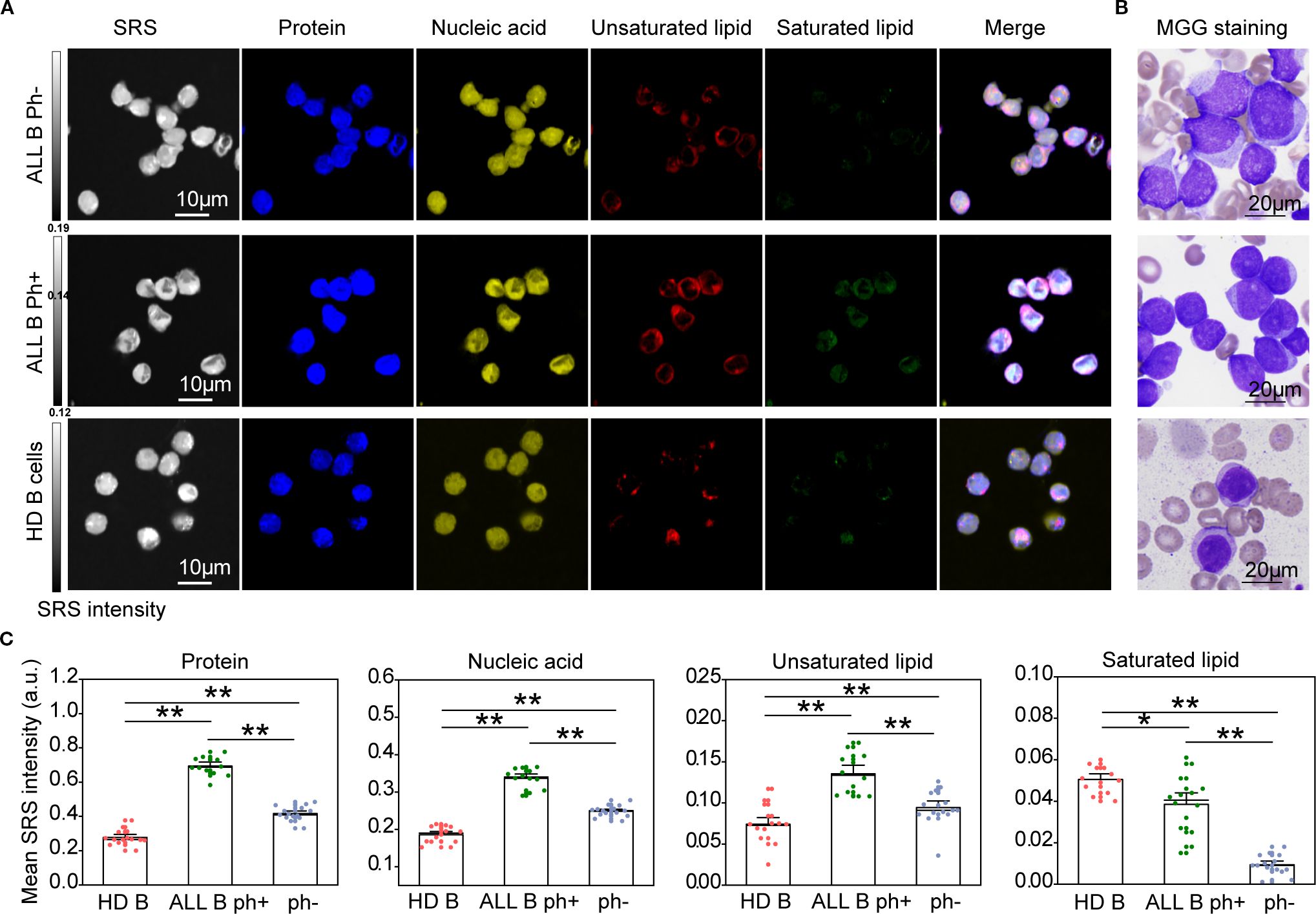 Panel A shows microscopy images of cells labeled with SRS imaging for proteins, nucleic acids, and lipids, alongside merged images. Three rows represent ALL B Ph-, ALL B Ph+, and HD B cells. Panel B displays MGG staining of corresponding cell types. Panel C presents bar graphs depicting mean intensity measurements for protein, nucleic acid, unsaturated lipid, and saturated lipid across the three cell types, highlighting significant differences with asterisks. Scale bars indicate magnification.