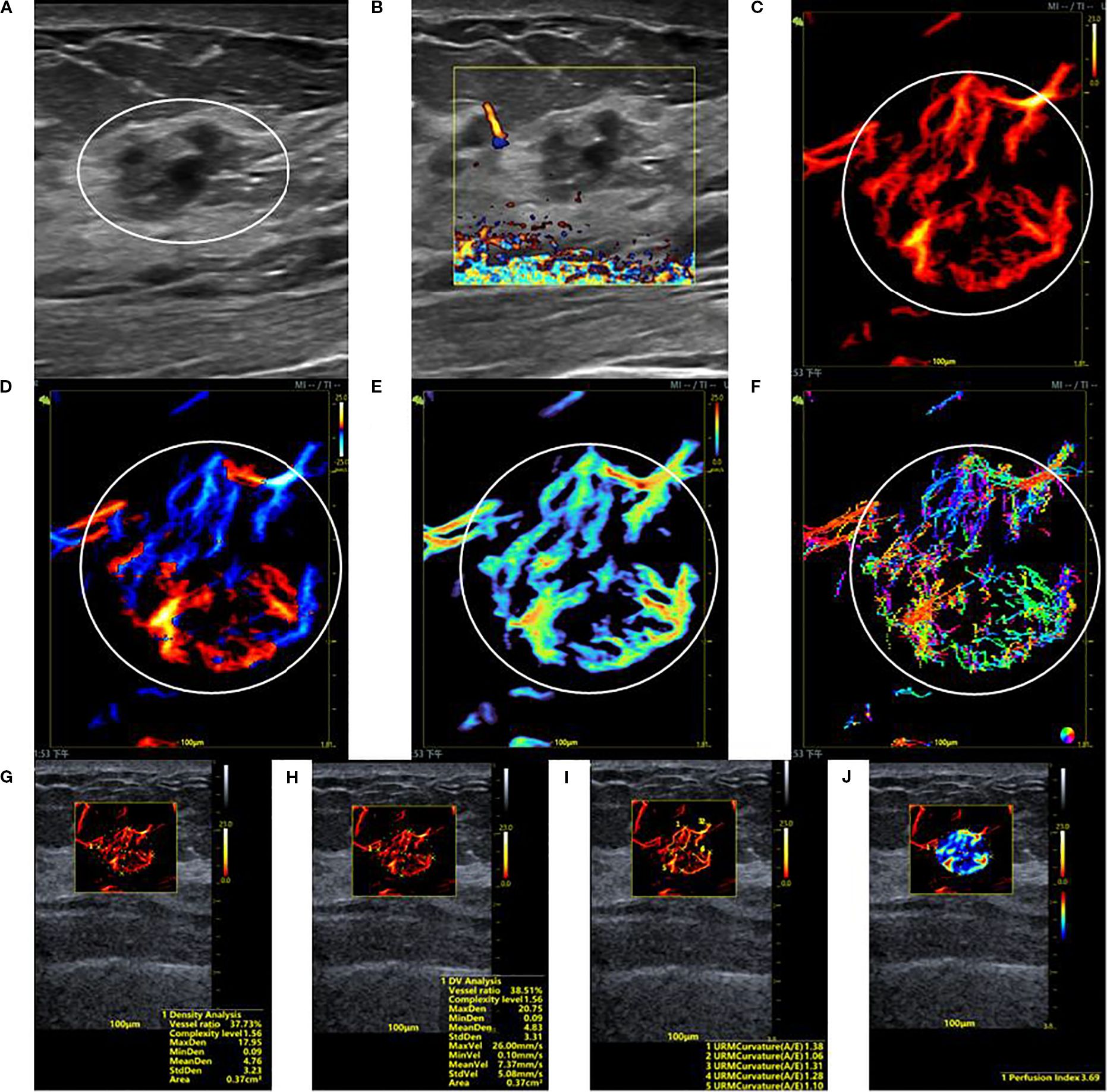 A series of ultrasound images of a hypervascular benign breast lesion. Panel A is a grayscale ultrasound showing a hypoechoic mass within a circular marker. Panel B is a Super Microvascular Flow (SMF) image. Panels C to F are SRUS parameter maps illustrating the lesion's Density, Orientation, Velocity, and Angle through distinct color schemes. Panels G to J present quantitative analysis panels with numerical data superimposed on the ultrasound scans.