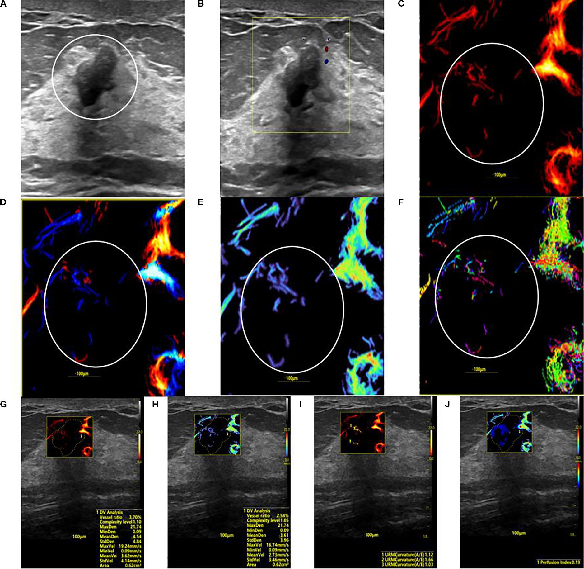 A series of ultrasound images of a hypovascular benign breast lesion. Panel A is a grayscale ultrasound displaying a hypoechoic mass encircled for reference. Panel B is a Super Microvascular Flow (SMF) image. Panels C through F are SRUS parameter maps depicting the lesion's characteristics via Density, Orientation, Velocity, and Angle color maps. Panels G through J are analysis panels showing numerical parameter values overlaid on the corresponding ultrasound images.