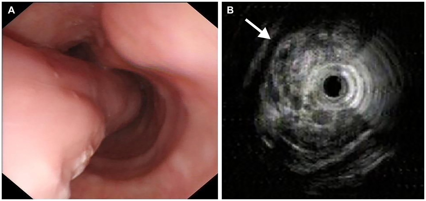 Image A shows an endoscopic view of the internal contours of the esophagus with a smooth, tubular structure. Image B is an ultrasound scan with concentric rings and an arrow indicating a specific area of interest.