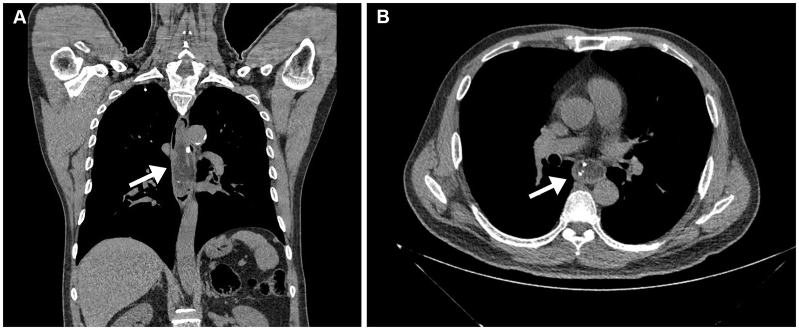Medical imaging showing two CT scans of the chest. Image A is a coronal view with an arrow pointing to the aortic arch, emphasizing an abnormality. Image B is an axial view highlighting the same area with another arrow.