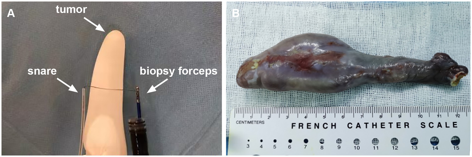 Panel A shows a medical snare and biopsy forceps next to a finger model labeled with a tumor. Panel B displays a removed, dark mass next to a ruler marked in centimeters, labeled