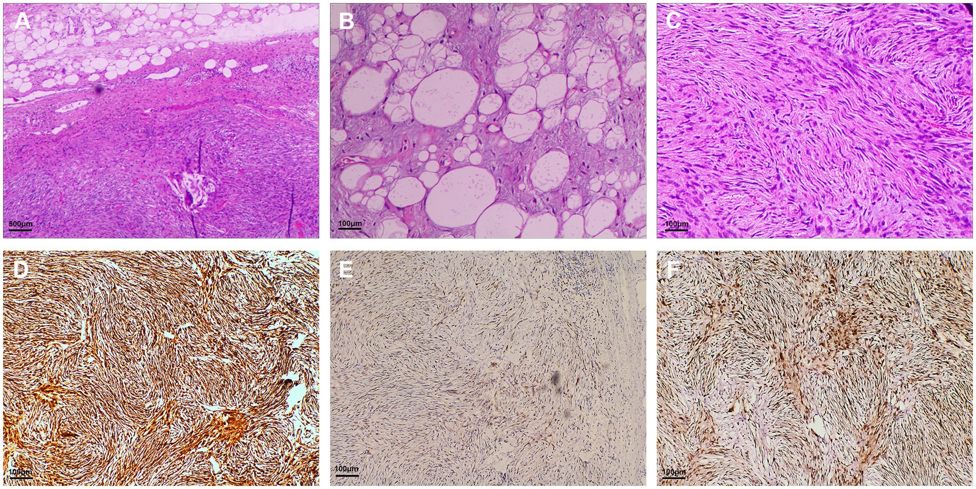 Microscopic images showing various tissue samples. Image A displays adipose and dermal tissue with white fat cells, stained with hematoxylin and eosin. Image B shows clusters of enlarged adipocytes. Image C highlights spindle-shaped cells with a fibrous texture. Image D illustrates a densely packed fibrous matrix. Image E shows less dense fibrous tissue with lighter staining. Image F reveals fibrous tissue with cells that appear brownish, indicating specific staining. Each image has a scale bar indicating magnification.