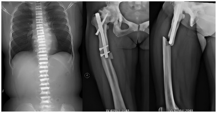 X-ray images showing a frontal view of a spine with scoliosis and two separate views of a femur with surgical hardware inserted into the bone. The images capture the curvature of the spine and the placement of the hardware in the femur for stabilization.