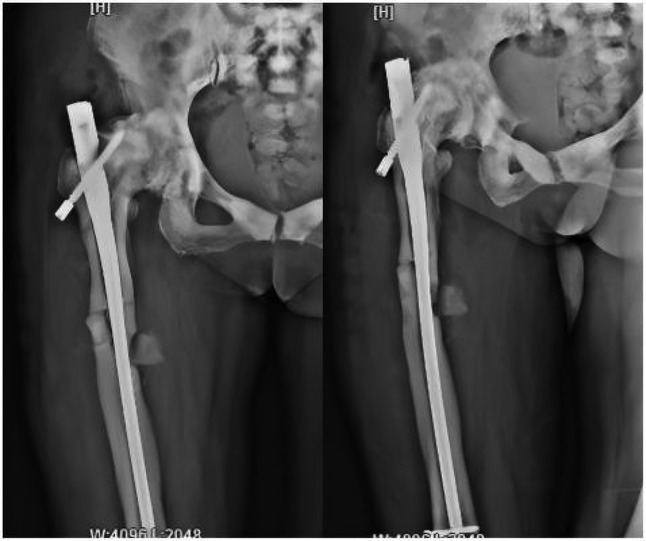 X-ray images of a pelvis and upper leg with an implanted metal rod. The rod is aligned along the femur, secured with screws near the hip. There is a noticeable fracture in the femur.