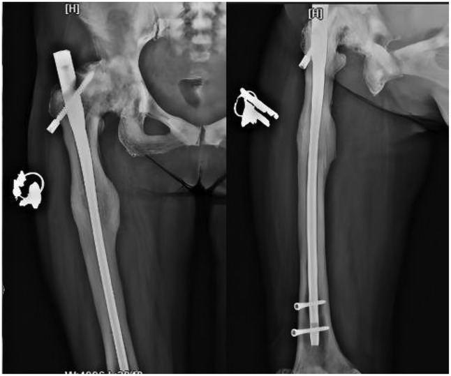 X-ray image showing a surgical repair of the femur with a long metal rod extending through the length of the bone. The left panel displays the upper portion near the hip joint, and the right panel shows the lower portion with securing screws near the knee.