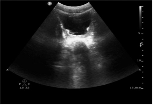 Ultrasound image showing a transverse abdominal view with a hypoechoic bladder centrally located. Depth markers are visible along the right side, extending to 15 cm.