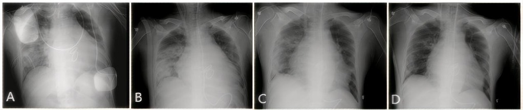 Four chest X-ray images labeled A to D show a progression of lung clarity. Image A displays significant opacities, while images B through D show increasing lung clarity and reduced opacities, indicating gradual improvement.