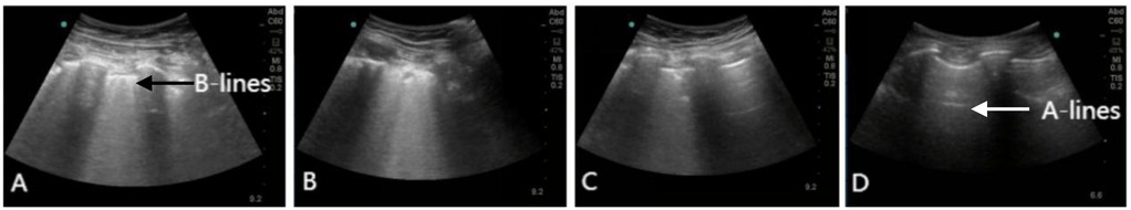 Four ultrasound images labeled A, B, C, and D. Image A shows an arrow pointing to B-lines, indicating vertical lines in the lung field. Images B and C display similar patterns of vertical lines. Image D has an arrow pointing to A-lines, indicating horizontal lines, which are normal reflections in lung ultrasound.