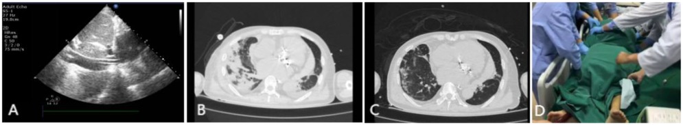 Panel A shows an echocardiogram of the heart. Panels B and C display CT scans of the chest, revealing abnormalities in lung structures. Panel D depicts a medical team in a surgical setting, preparing a patient covered with green drapes.
