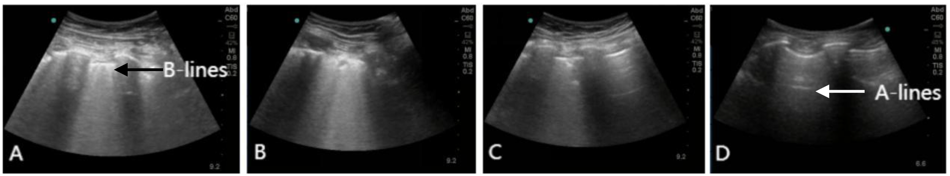 Four ultrasound images labeled A, B, C, and D. Image A shows an arrow pointing to B-lines, indicating vertical lines in the lung field. Images B and C display similar patterns of vertical lines. Image D has an arrow pointing to A-lines, indicating horizontal lines, which are normal reflections in lung ultrasound.