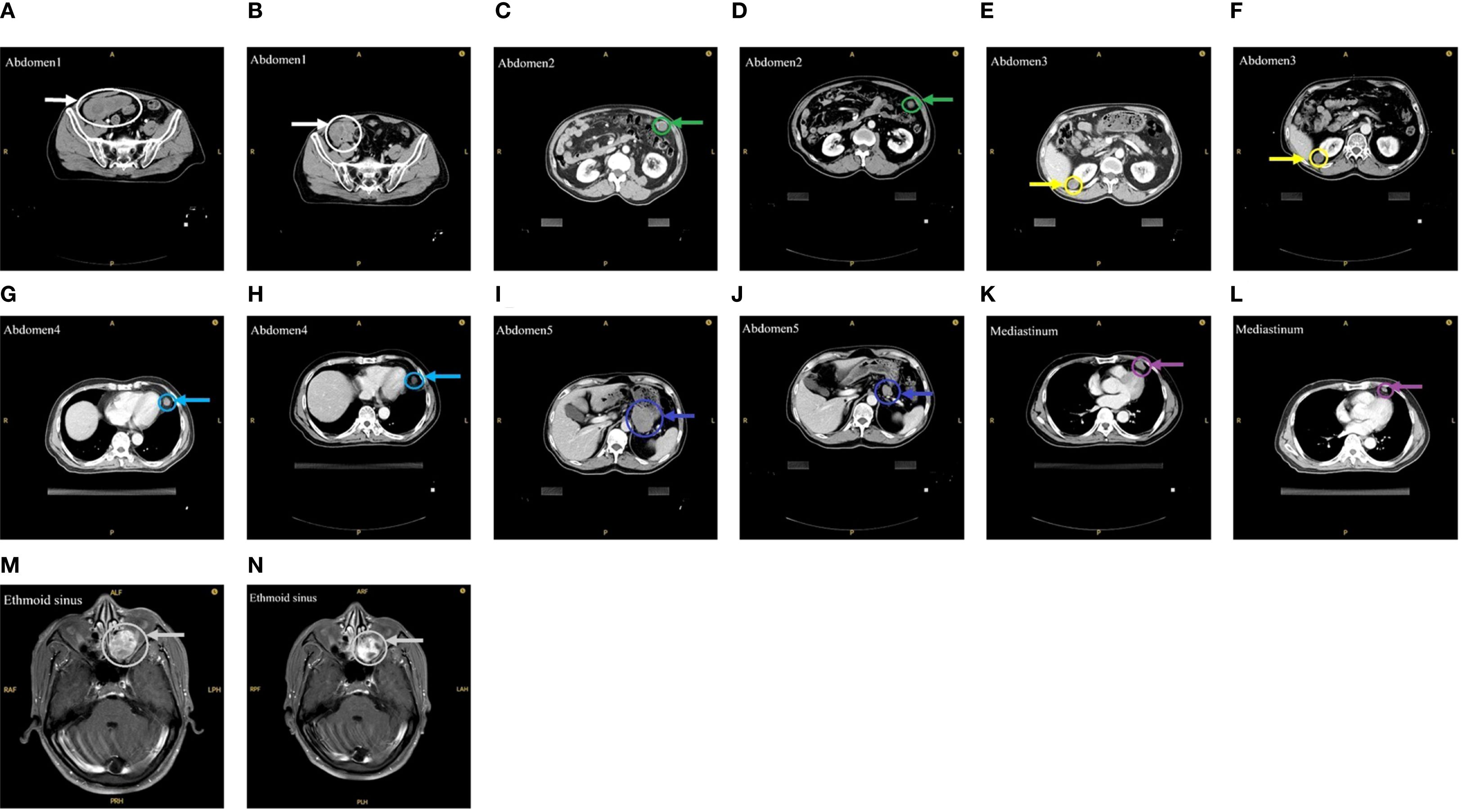 Twelve axial CT scan images labeled A to N, showing different abdominal and mediastinal sections. Each image features an arrow pointing to a highlighted area, indicating regions of interest: white arrows in A and B, green in C and D, yellow in E and F, blue in G to J, purple in K and L, and gray in M and N. The labels specify different abdominal sections and the ethmoid sinus.