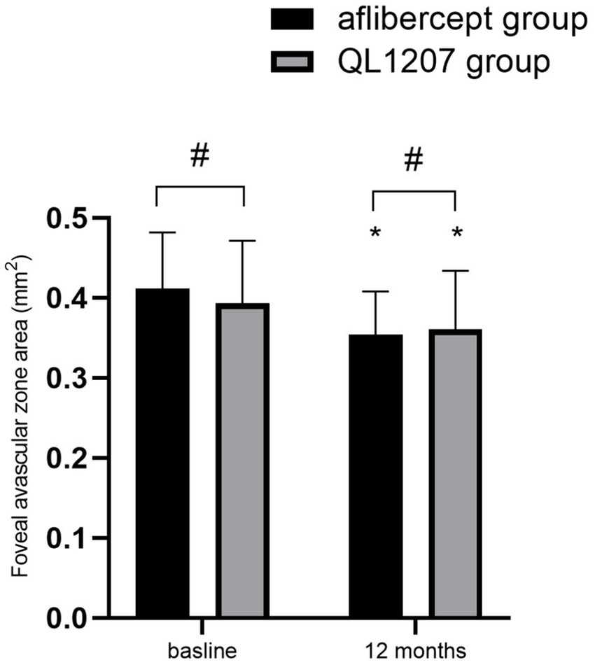 Bar graph comparing the foveal avascular zone area at baseline and 12 months between the aflibercept group (black bars) and QL1207 group (gray bars). Both groups show similar baseline values around 0.4 mm². At 12 months, both groups show a small reduction with significant differences marked by asterisks, though values remain close for both groups. The hashtag symbol indicates statistical significance.