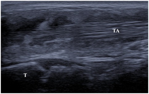 Ultrasound image showing labeled structures, \