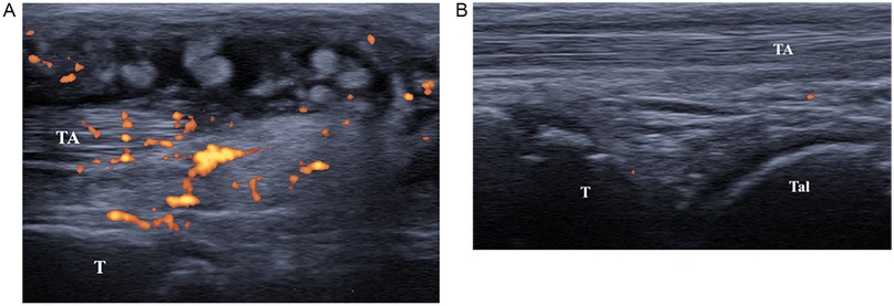 Ultrasound images labeled A and B. Image A shows an inflamed Tibia (T) and Tibialis Anterior (TA) with increased blood flow indicated by orange Doppler signals. Image B shows a normal Tibia (T) and Tibialis Anterior (TA) with minimal blood flow signals.