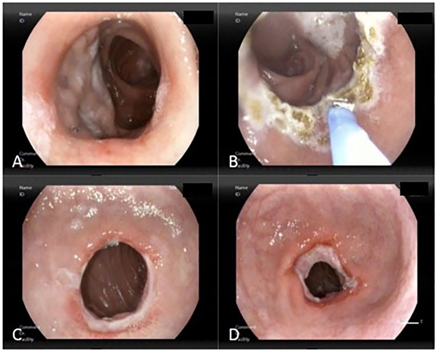 Four endoscopic images of the esophagus show various stages of treatment. Image A shows an esophageal obstruction. Image B displays a procedure with a tool clearing the obstruction. Image C reveals a cleared passage. Image D illustrates a fully open esophageal lumen post-procedure.