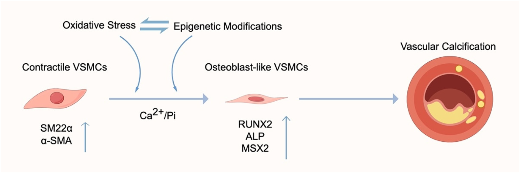 Diagram illustrating the process of vascular calcification. Contractile vascular smooth muscle cells (VSMCs) labeled SM22α and α-SMA, influenced by oxidative stress and epigenetic modifications, transform into osteoblast-like VSMCs with markers RUNX2, ALP, and MSX2. Calcium and phosphate (Ca²⁺/Pi) contribute to this transformation, leading to vascular calcification.
