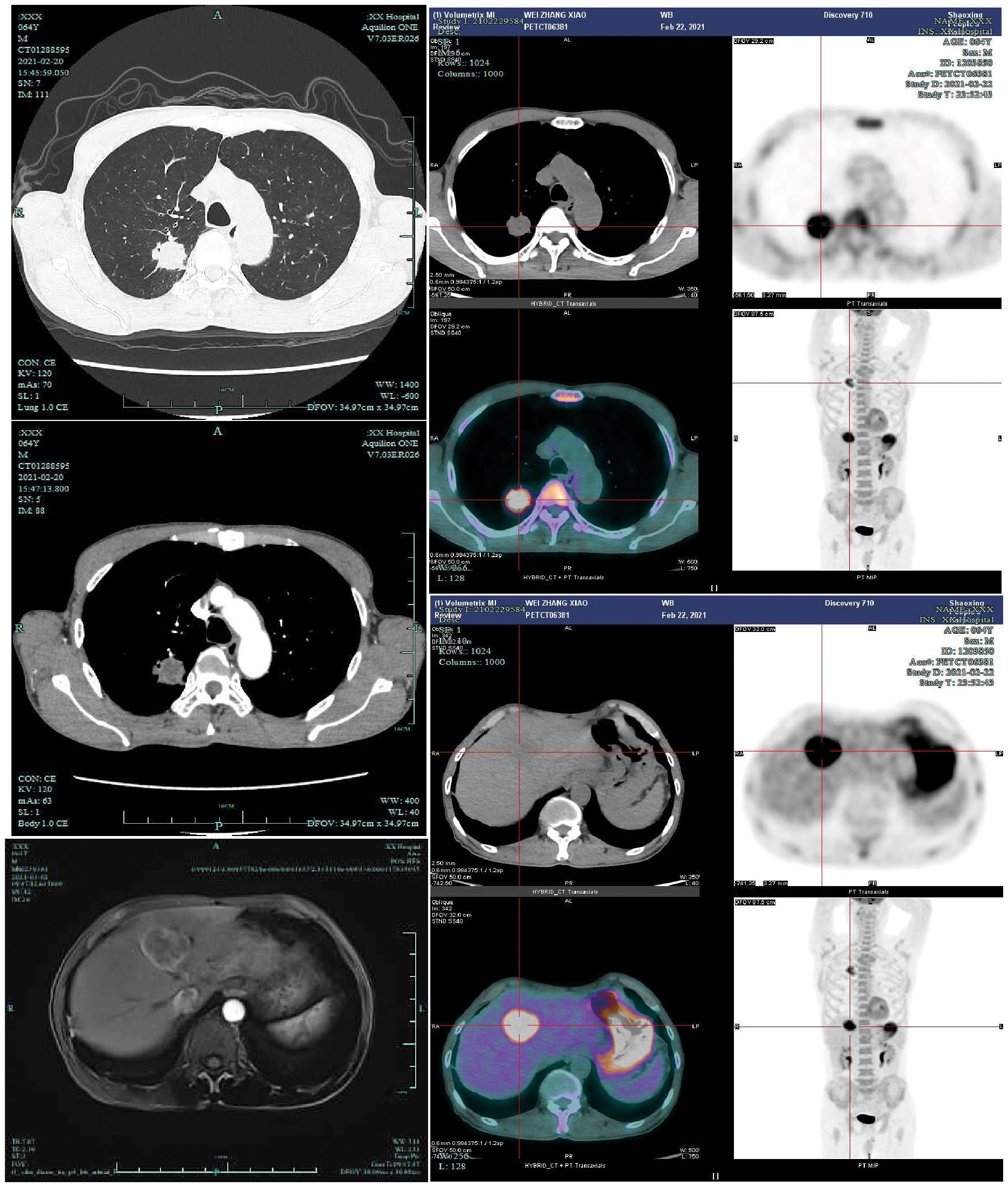 A composite image displaying various medical scans, including a CT scan, PET/CT hybrid images, and MRI. The scans show cross-sectional views of the thoracic and abdominal regions, highlighting different tissue densities and structures. Bright spots in some images may indicate areas of higher activity or contrast, often used for diagnostic purposes. Each scan includes calibration markers and textual data related to settings and patient information, hinting at their use in medical analysis and assessment.