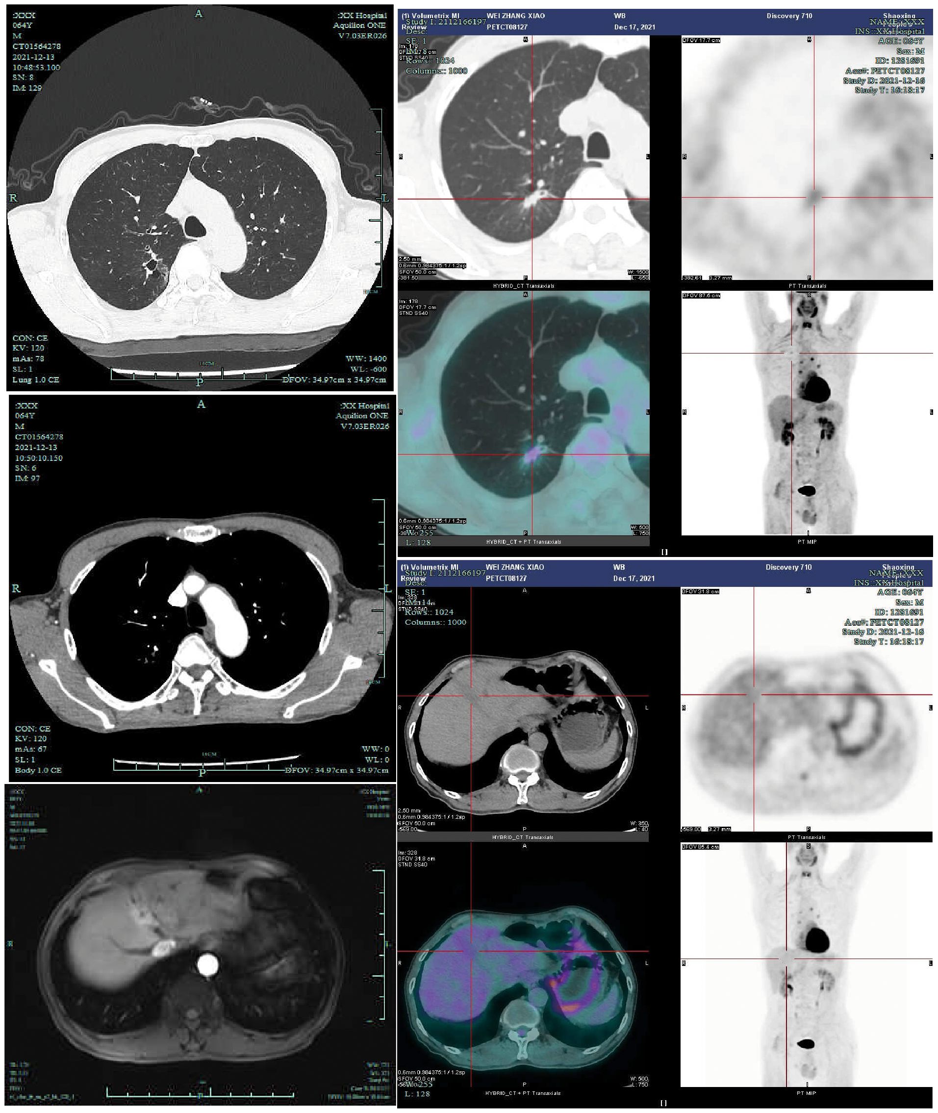 A series of medical imaging scans, including CT and PET scans, show various cross-sections and views of human anatomy. The images on the left display axial CT scans of the chest and abdomen. On the right, PET scans highlight areas with metabolic activity using color overlays. Some images also show coronal and sagittal views. The scans are marked with reference lines for alignment and measurement.