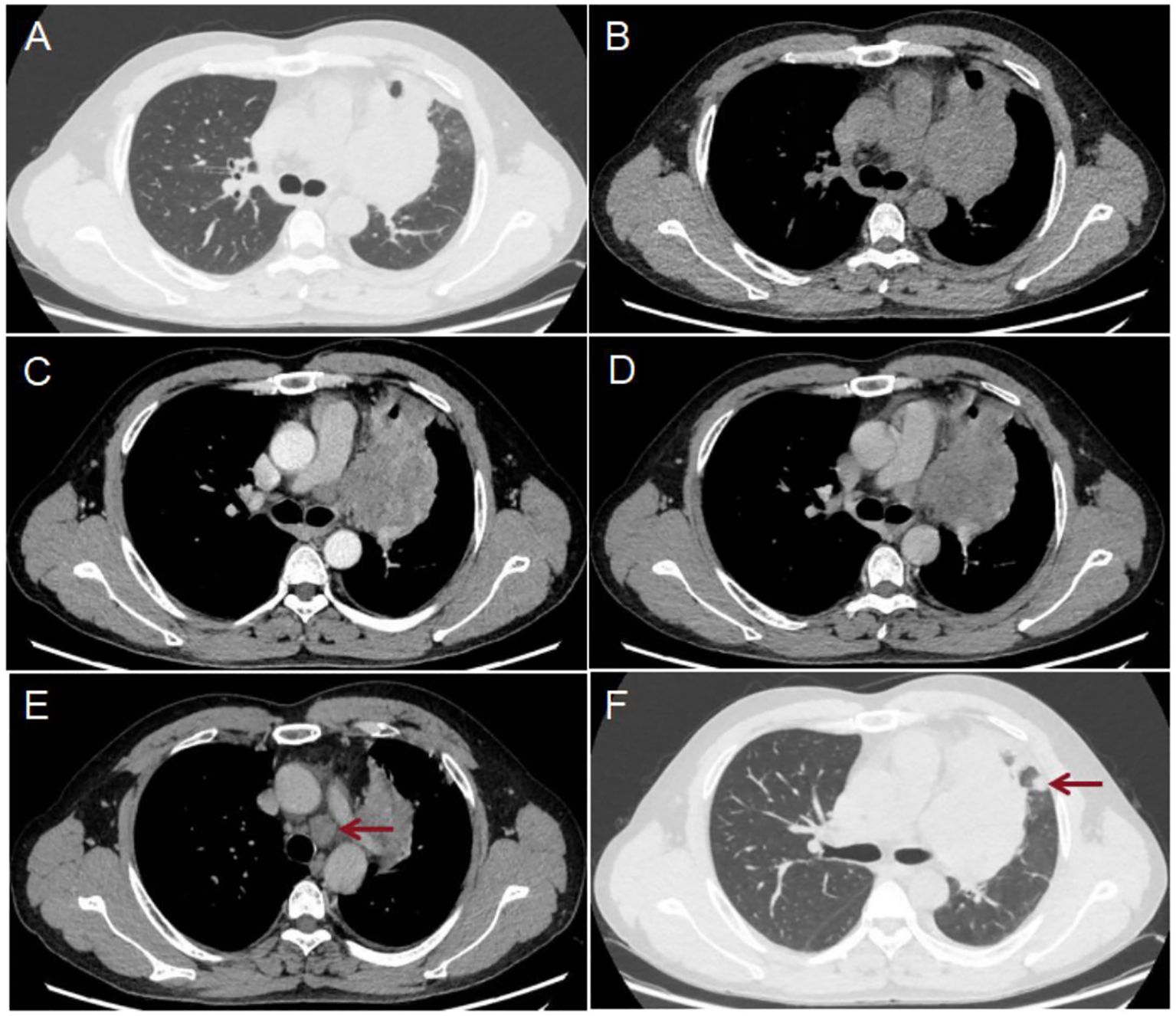Six-panel medical imaging series showing CT scans of a chest at different stages. Panels A and F are brighter, displaying more lung detail, while B to E are darker. Panel E has a red arrow pointing to a highlighted area near the heart, indicating a point of interest. Panel F also has a red arrow pointing to a spot in the lung.