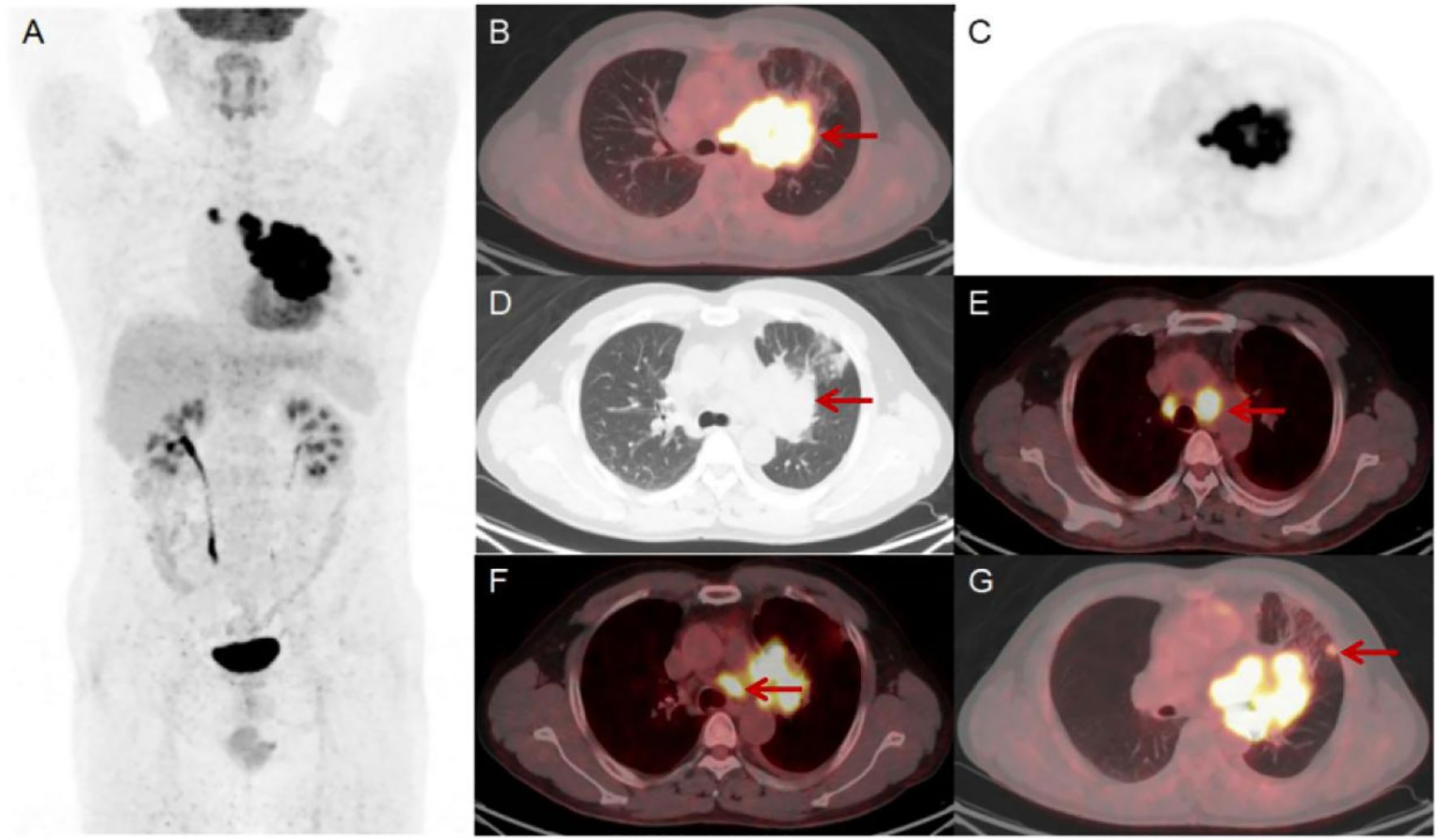 Medical imaging showing various scans of the chest. Panel A displays a full-body PET scan with highlighted areas in the chest and pelvis. Panels B, D, F, and G show axial PET-CT images of the lungs with arrows indicating regions of increased uptake or abnormality. Panels C and E are similar but appear to be different imaging modalities or sections, also highlighting areas of concern.
