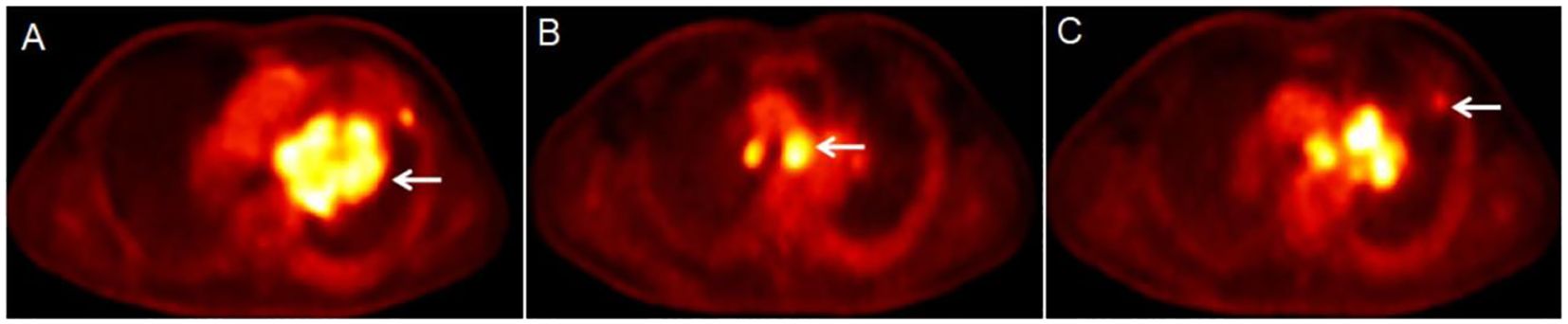 Three PET scan images labeled A, B, and C show areas of varying light intensity within a reddish field. Each image features an arrow pointing to a bright spot, highlighting areas of interest.