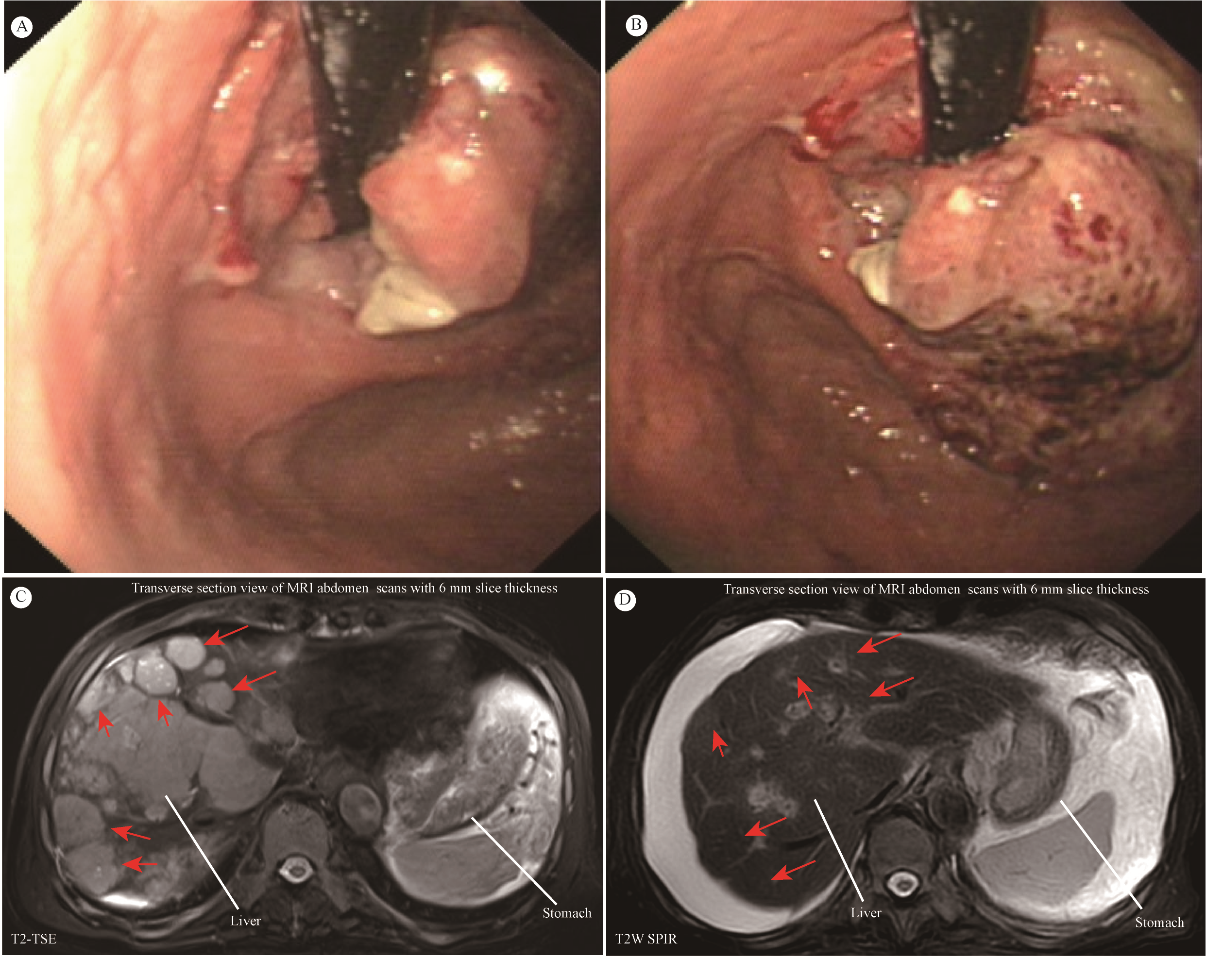 Gastrointestinal endoscopy and MRI images are shown. Panel A shows an endoscopic view of a gastrointestinal lesion, which occupies approximately one-third of the gastric fundus area and is accompanied by ulceration, induration, and active bleeding. Panel B provides a closer view of the same lesion, revealing ulcerative changes. Panels C display transverse abdominal MRI scans, highlighting the gastric cancer and multiple hepatic metastatic lesions; red arrows indicate potential abnormal regions. Panel D demonstrates significant interval regression of multiple hepatic metastases and a substantial reduction in portal vein thrombus burden compared with previous examinations.