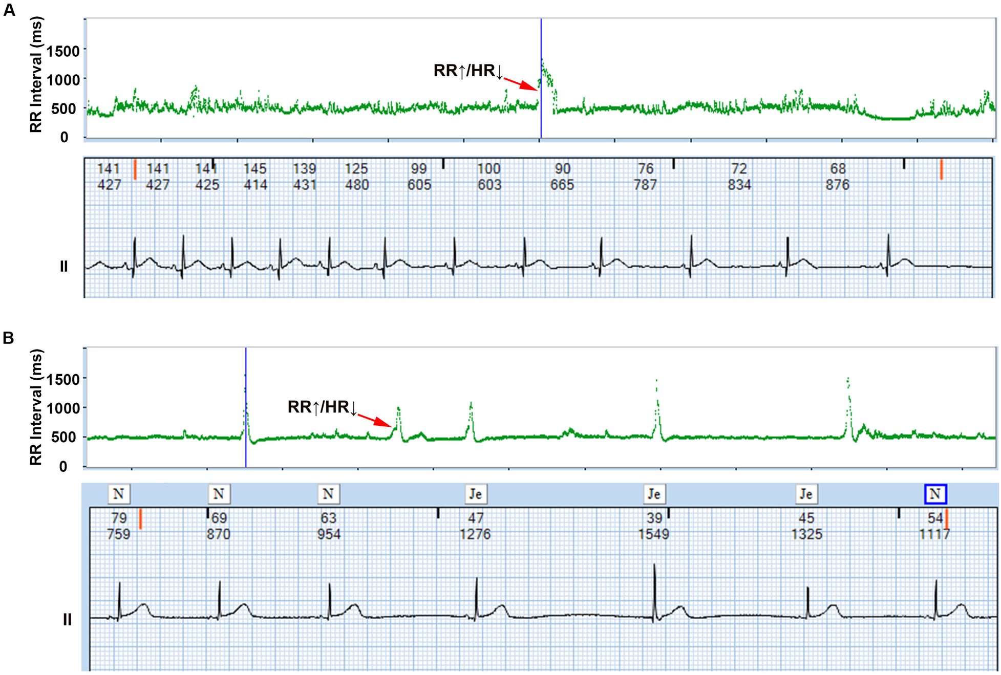 Two ECG graphs labeled A and B show RR interval trends and corresponding heart rate patterns. Graph A shows a stable RR interval with a sudden spike marked by a red arrow labeled \"RR↑/HR↓\". Graph B shows a similar pattern with periodic fluctuations and another spike similarly labeled. Each graph includes a lower section displaying detailed ECG traces over time.