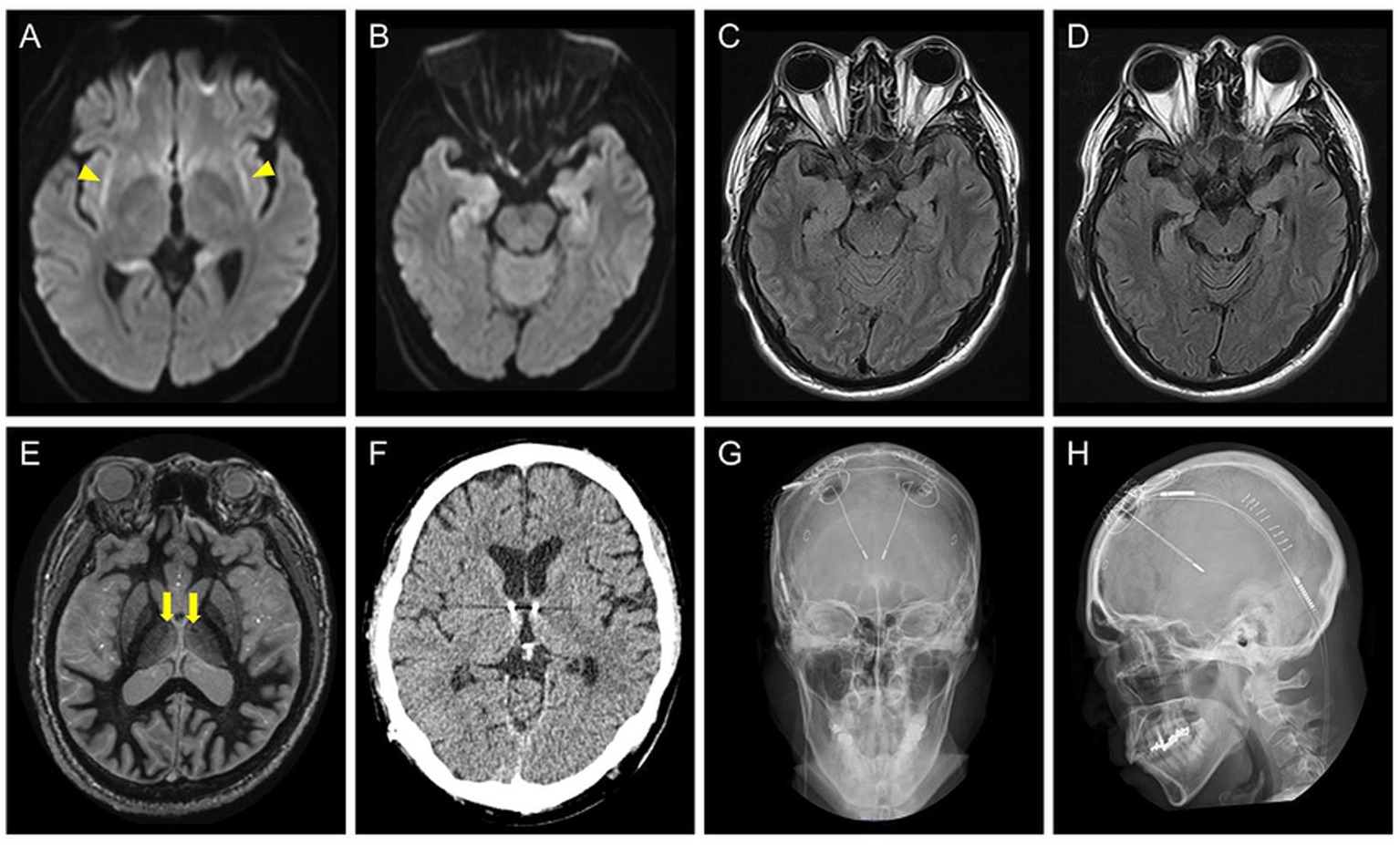 Eight medical images showing various head scans. Image A displays diffusion-weighted imaging with arrows indicating abnormal areas. Image B is a similar scan without highlights. Images C and D are MRI scans of the brain. Image E is an MRI with arrows pointing to specific areas. Image F is a CT scan of the brain. Images G and H are X-rays showing the skull and electrode implants from different angles. Each image focuses on different features for diagnostic purposes.