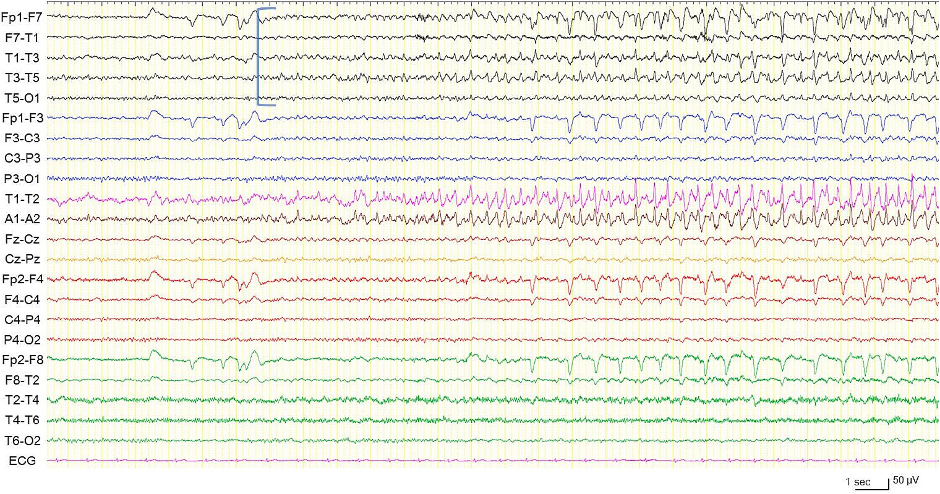 Electroencephalogram (EEG) showing multiple channels of brain wave activity. Each line represents electrical activity between different electrode pairs, labeled on the left. Electrographic seizure is arising from the left temporal region (blue square bracket). A time scale of one second and a voltage scale of fifty microvolts are shown.