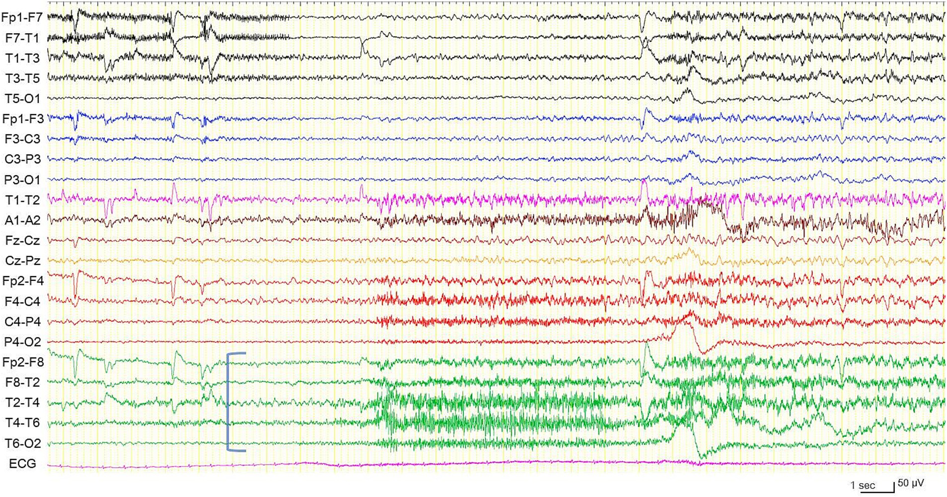 Electroencephalogram (EEG) showing multiple channels of brain wave activity. Each line represents electrical activity between different electrode pairs, labeled on the left. Electrographic seizure is arising from the right temporal region (blue square bracket). A time scale of one second and a voltage scale of fifty microvolts are shown.