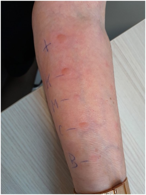 Forearm with red patches beside blue markings, labeled as \