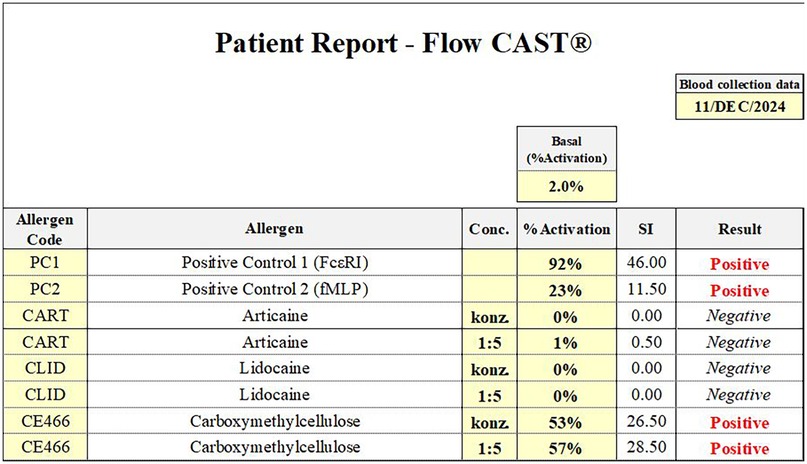 Patient report table for Flow CAST testing with data collected on December 11, 2024. It shows allergen codes, allergens, concentrations, percentage activation, stimulation index (SI), and results. Positive controls show a high activation and positive result. Articaine and Lidocaine tests have negative results. Carboxymethylcellulose shows a positive result. Basal activation is at two percent.