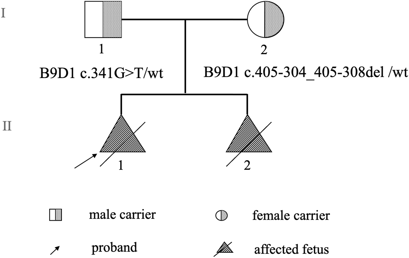 Pedigree chart illustrating genetic inheritance. Generation I shows a male carrier (square) with B9D1 c.341G>T/wt and a female carrier (circle) with B9D1 c.405-304_405-308del/wt. Generation II displays two affected fetuses (triangles) with proband indicated on the left.