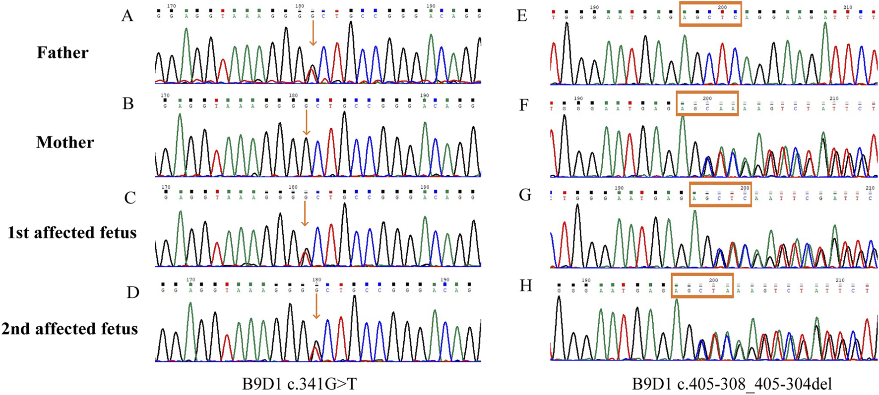 Genetic sequences for a family, showing chromatograms with specific DNA patterns. Panels A to D depict the father, mother, and two affected fetuses, highlighting a B9D1 c.341G>T mutation. Panels E to H show the same individuals with a B9D1 c.405-308_405-304del deletion. Arrows and boxes emphasize mutation sites.