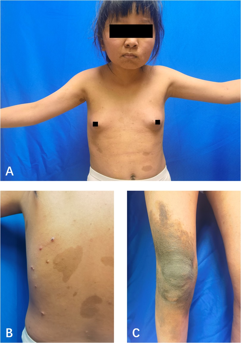 Child with hyperpigmented skin patches and lesions. Panel A shows the child's torso with several brown patches. Panel B is a close-up of similar skin patches and small lesions on the torso. Panel C displays the knee with darker pigmentation.